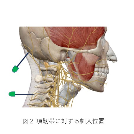 項靭帯に対する刺入位置