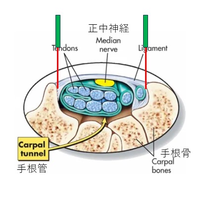 手根管症候群刺鍼横断面