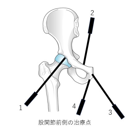股関節前側の治療点