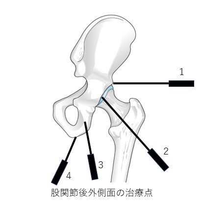 股関節後外側面の治療点