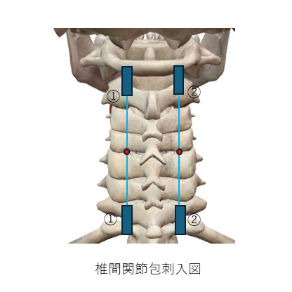 椎間関節包刺入図