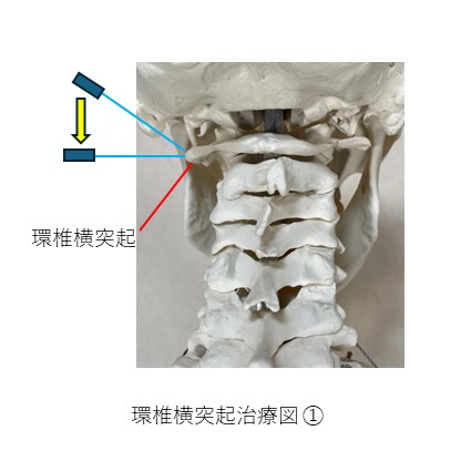 環椎横突起治療部位１