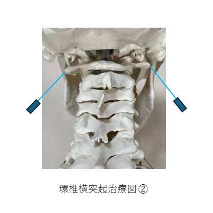環椎横突起治療部位２