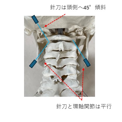 環軸関節包治療図１