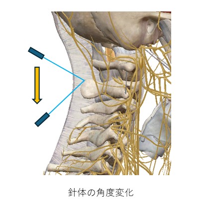 軸椎針体角度変化
